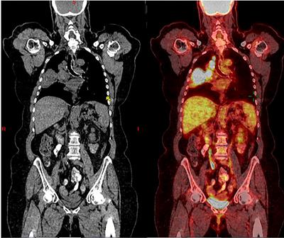 Overcoming CEP85L-ROS1, MKRN1-BRAF and MET amplification as rare, acquired resistance mutations to Osimertinib